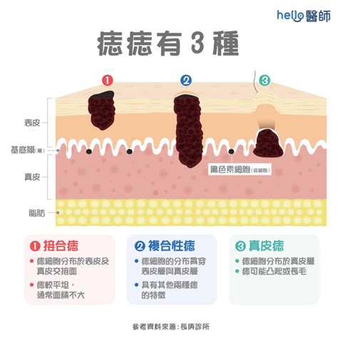 算命長毛的痣|痣長毛恐致命？真相曝光